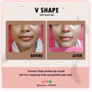 Vshape 2 Gold