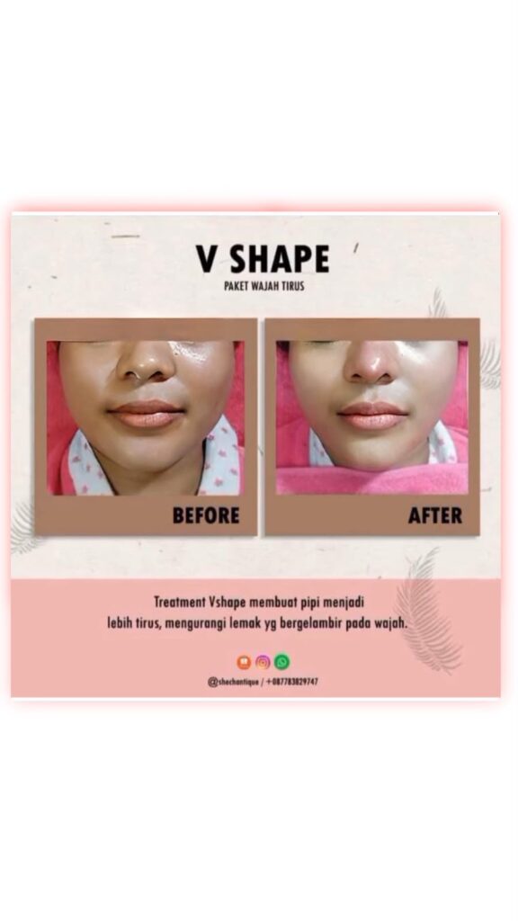 Vshape 2 Gold